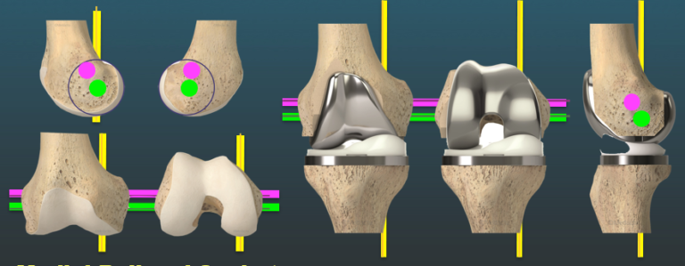 החלפת ברך בשיטה הקימינטית